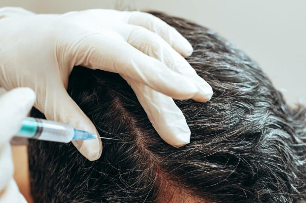 Cosmetologist performs anti-aging procedures into scalp hair growth prevention hair loss man