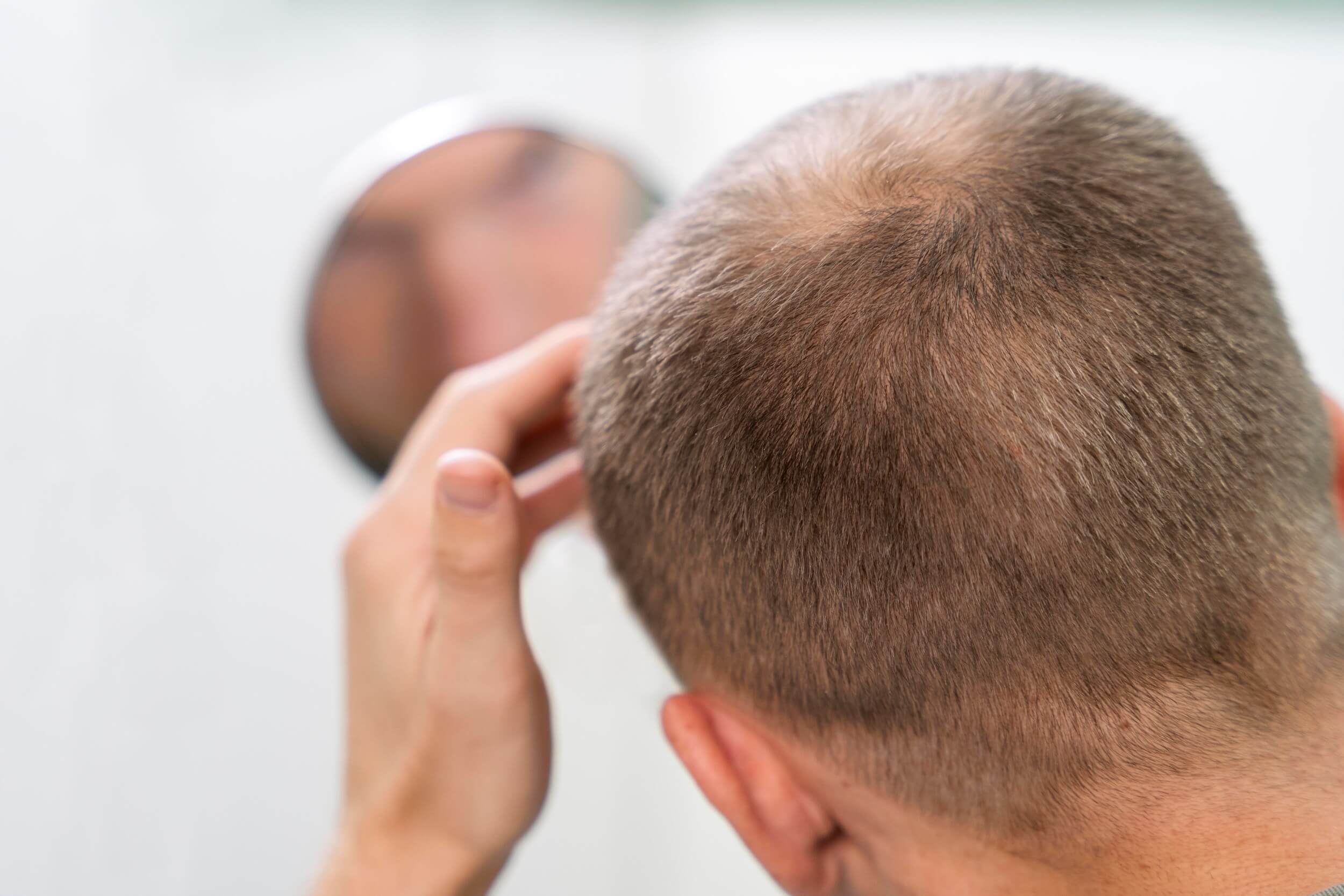 Imagen de la parte de atrás de la cabeza de un hombre que ha perdido mucho cabello, se está mirando en el espejo quiere un injerto capilar FUE DHI