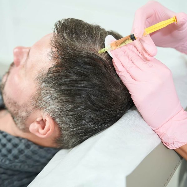 Cosmetologist performs a plasma-lifting procedure in the scalp